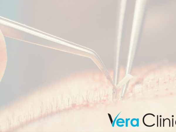 Understanding the Average Costs of Hair Transplantation in Turkey